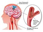 ยารักษาโรคหลอดเลือดในสมองตีบ cure vein obstruck 30แคปซูล
