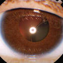 กลุ่มอาการผิดปกติทางสายตาและการมองเห็น